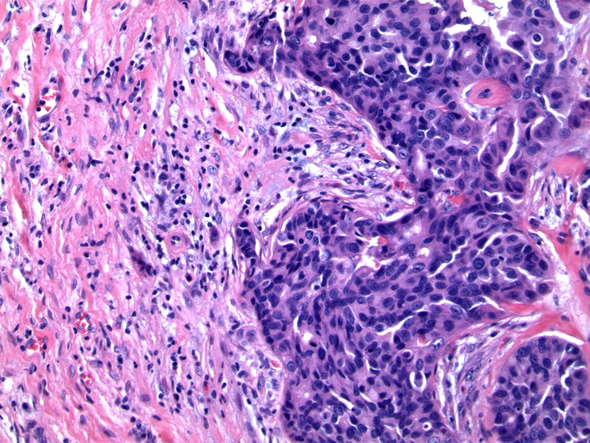 Image 5. Granulation tissue contains occasional degenerating epithelial cells, characteristic of previous biopsy procedure.