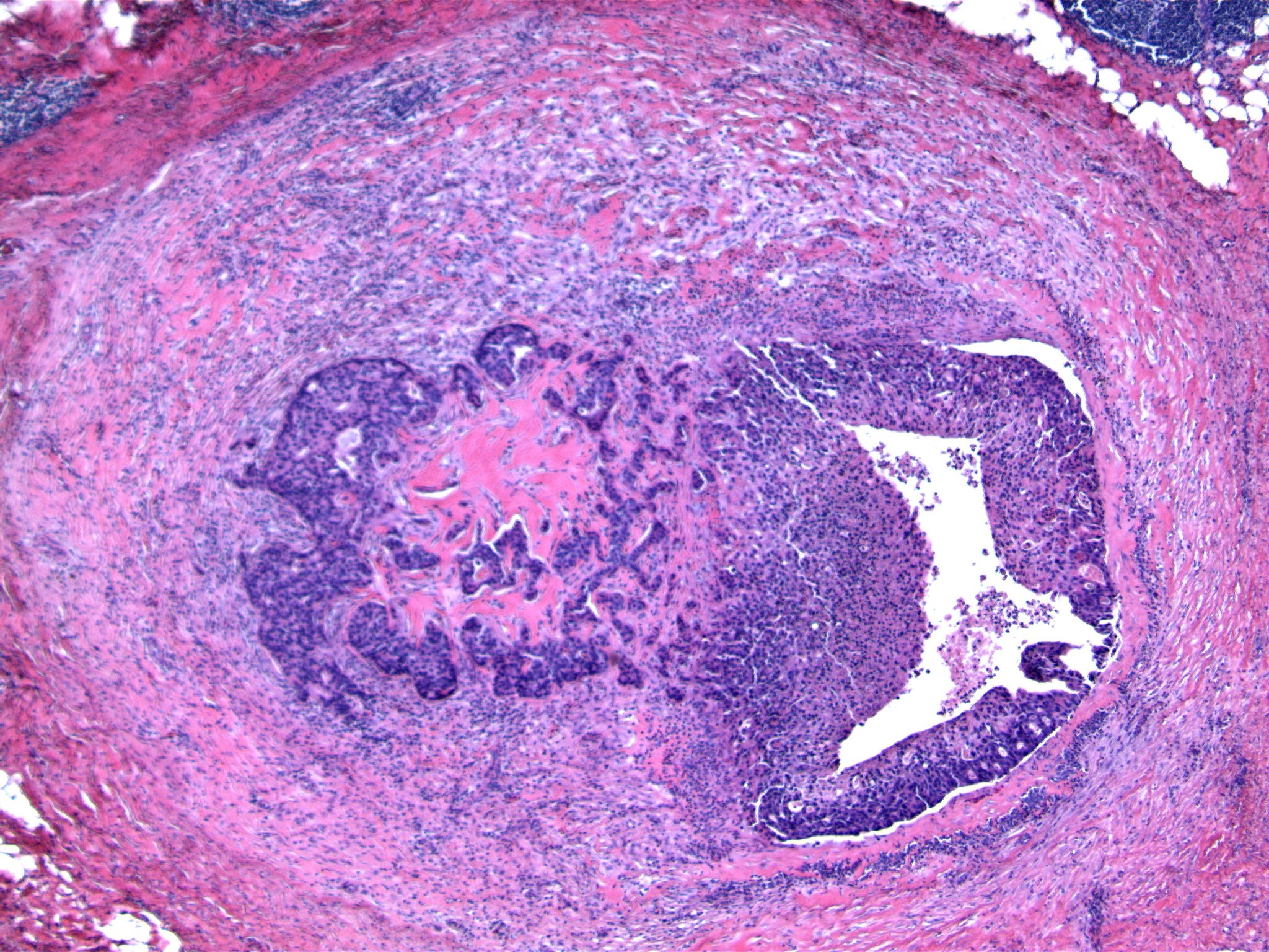 Image 2. The right side of the image shows ductal carcinoma in situ, bounded by intact duct wall. The left side of the image shows irregular nests of neoplastic cells mixed with hyalinized material, and disruption of the encircling fibrous tissue.