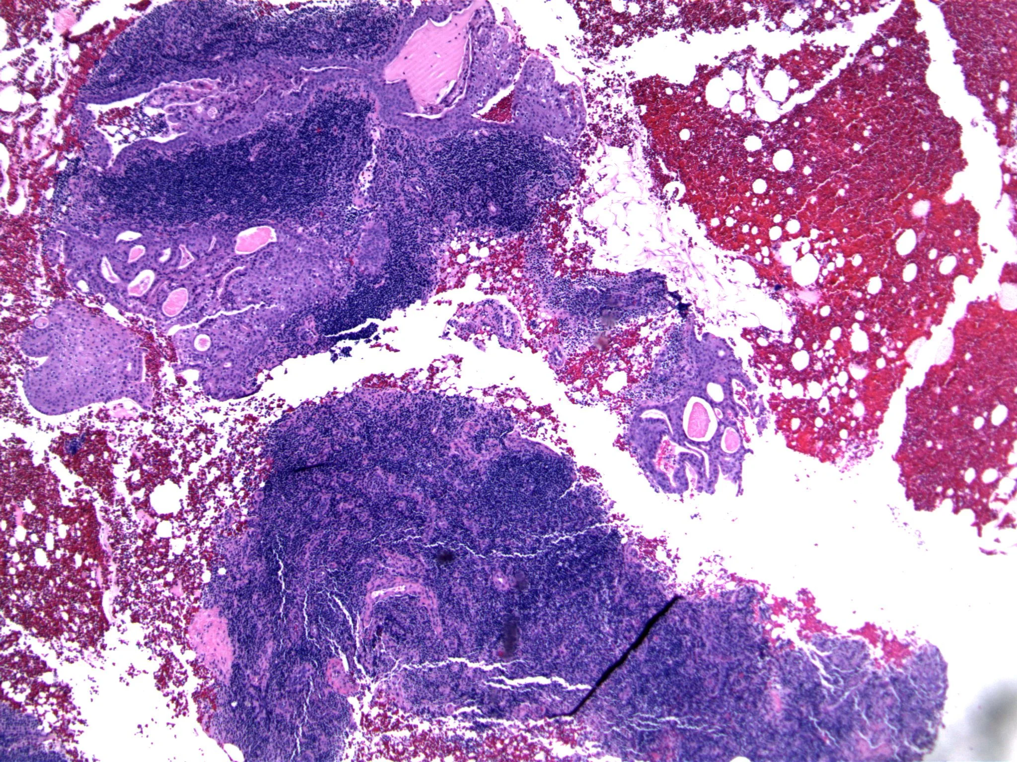 Image 1. The core biopsy of the lymph node contains epithelium, with areas of squamous metaplasia.