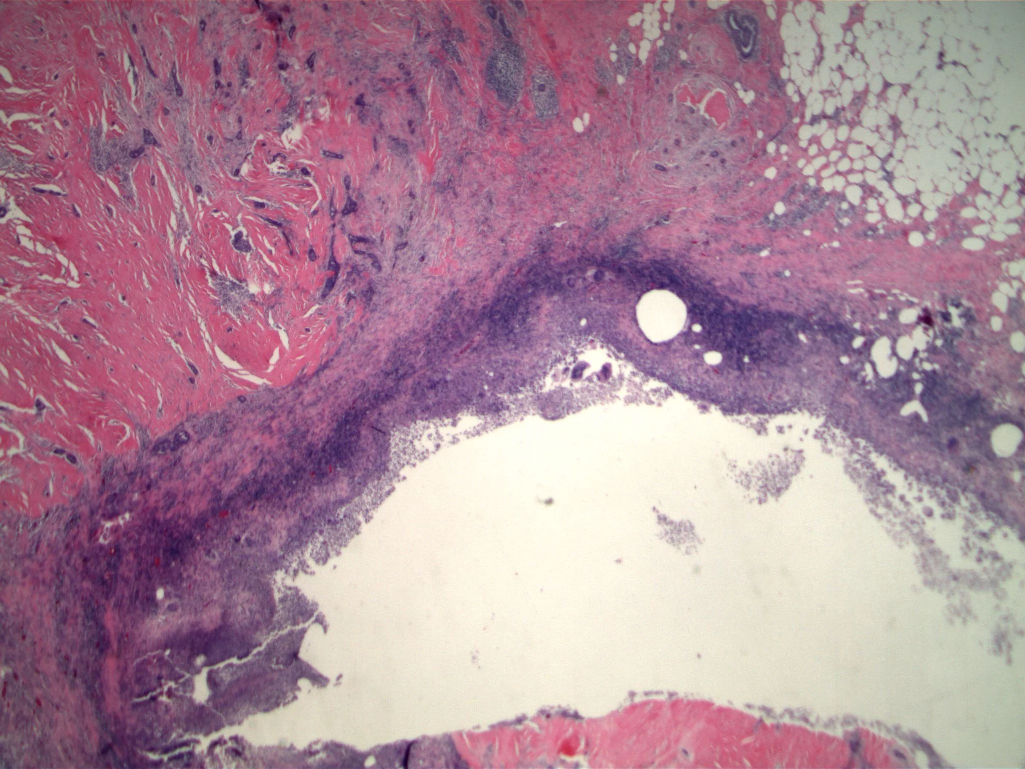 Image 2. The low grade adenosquamous carcinoma, originally diagnosed on core biopsy was present in the lumpectomy specimen. Note previous biopsy site