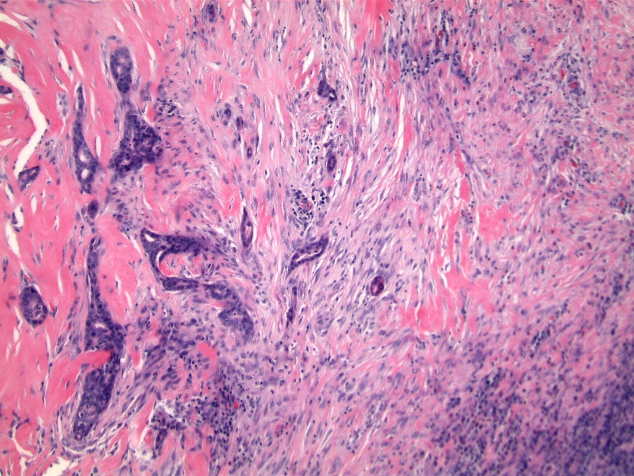 Image 3. Bland glandular structures, spindled cells and squamoid nests are characteristic of this special type low grade metaplastic carcinoma. Previously, immunohistochemical studies had been performed on the core biopsy specimen which showed the spindled cells to express p63 and cytokeratins.