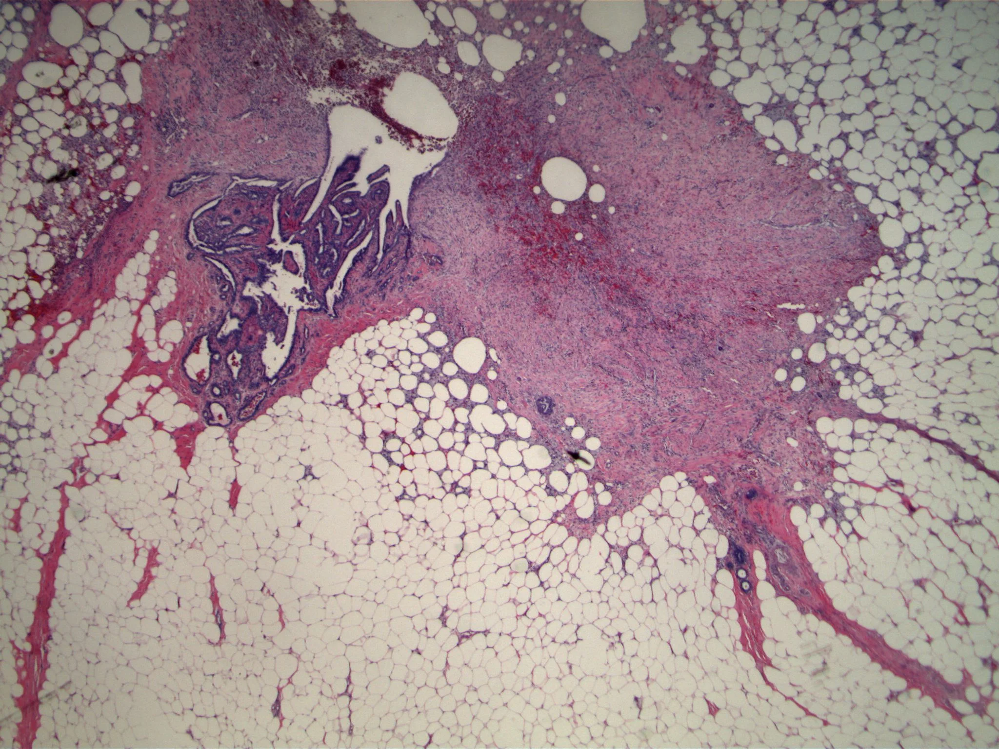 Image 4. The previously biopsied second breast nodule is an intraductal papilloma; note biopsy site changes.