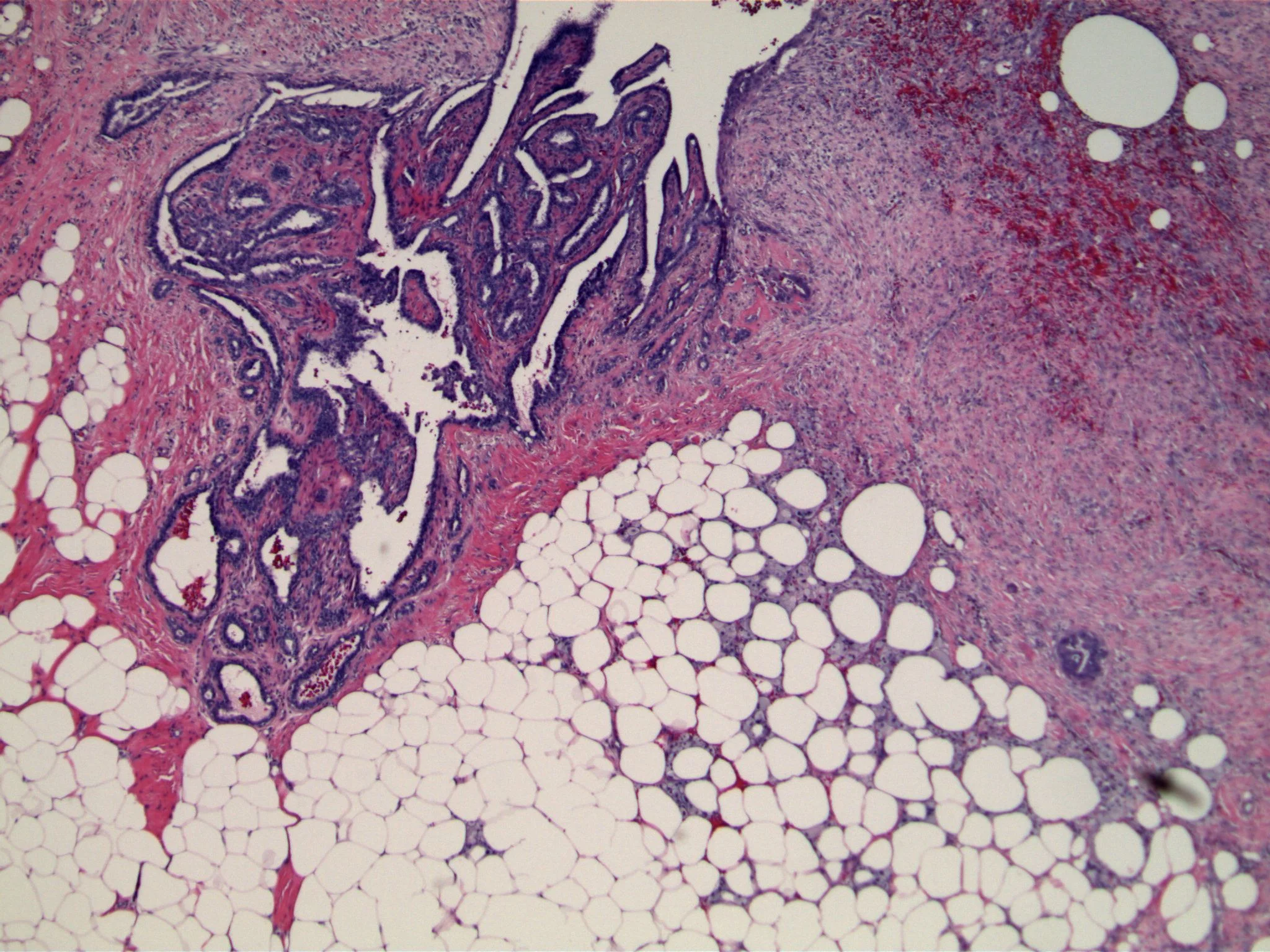 Image 5. There is minimal epithelial proliferation associated with this benign intraductal papilloma.