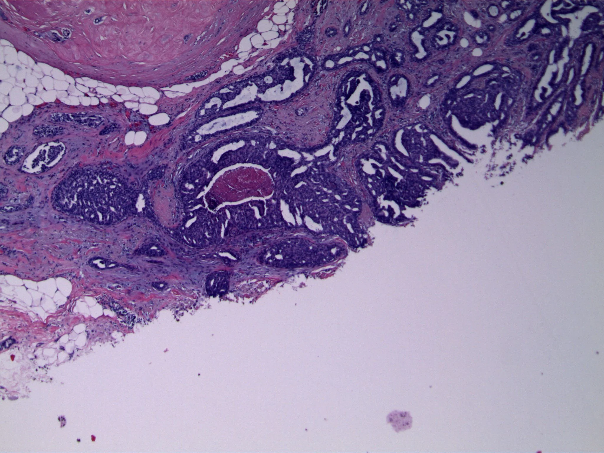 Image 1. An exuberant epithelial proliferation is present, associated with a sclerosed micropapilloma (upper left). Focal luminal necrosis is present.