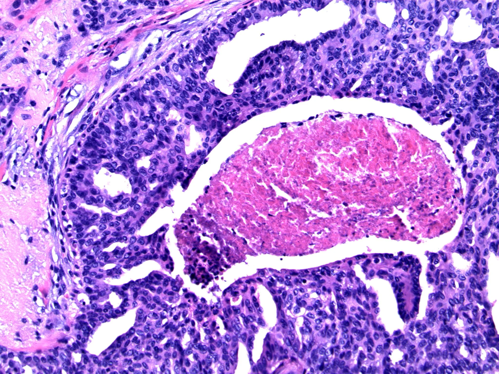 mage 3. Indistinct cell borders, nuclear variability and overlap are associated with central necrosis. 