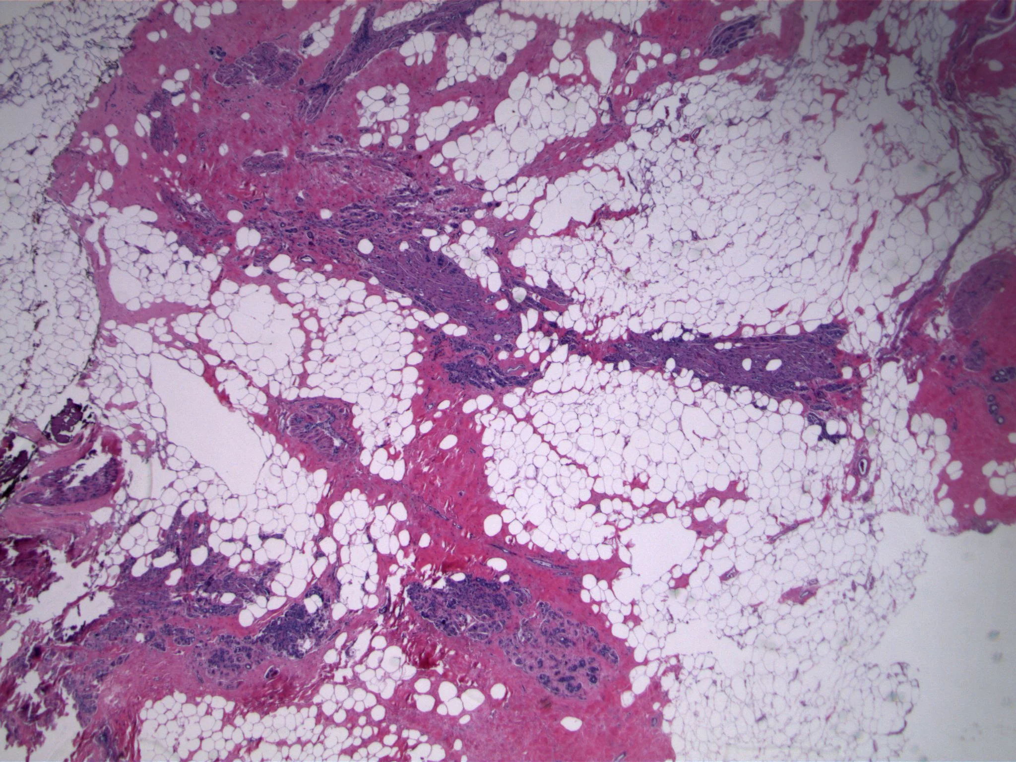 Image 1. The biopsy specimen contains sclerosing adenosis, characterized by a proliferation of small, elongated glandular structures that are arranged parallel to each other. At low power, the maintenance of a lobulocentric configuration is evident. 