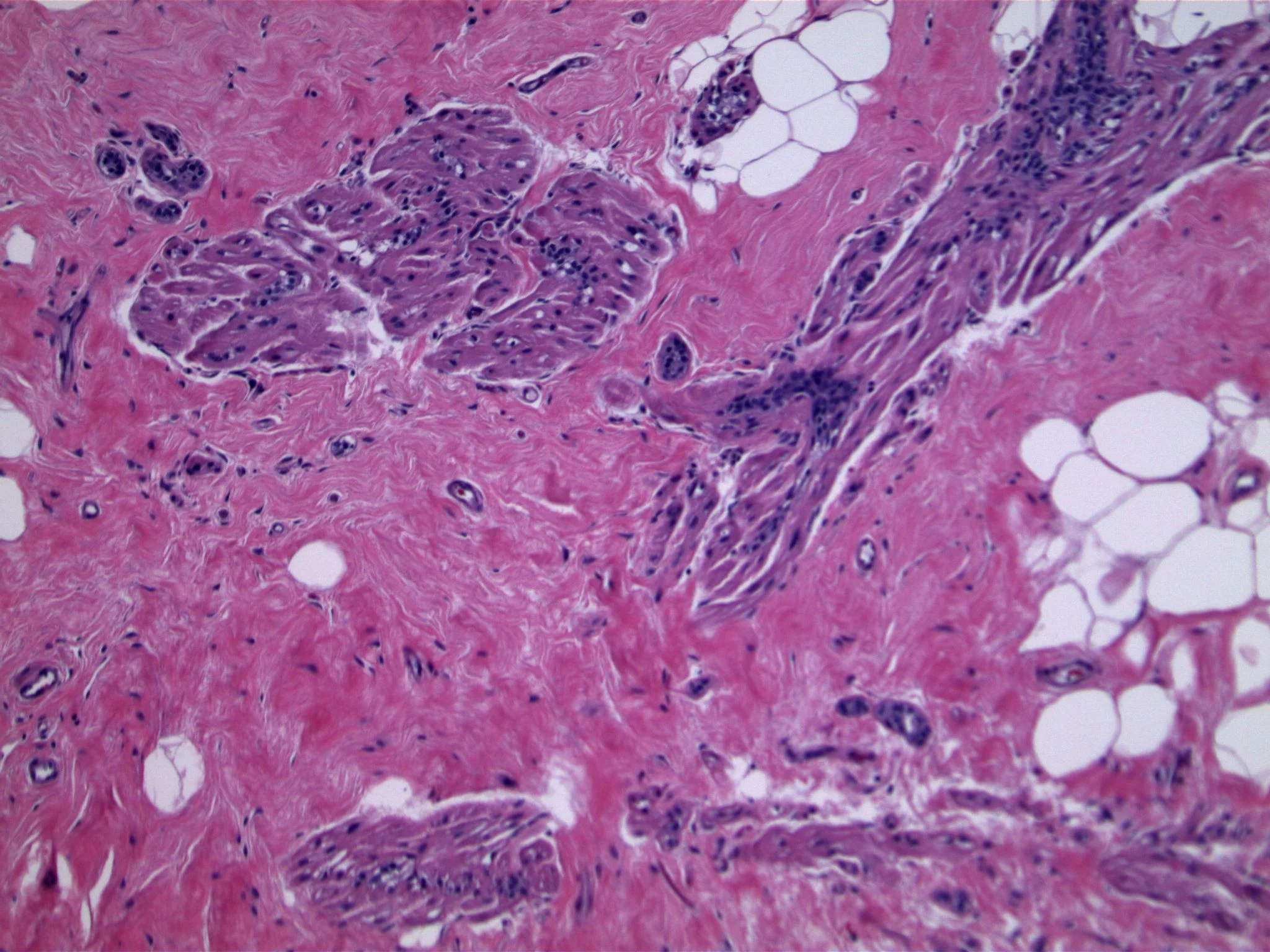 Image 4. The original lobular units and terminal duct are evident, although the myoid component predominates. 