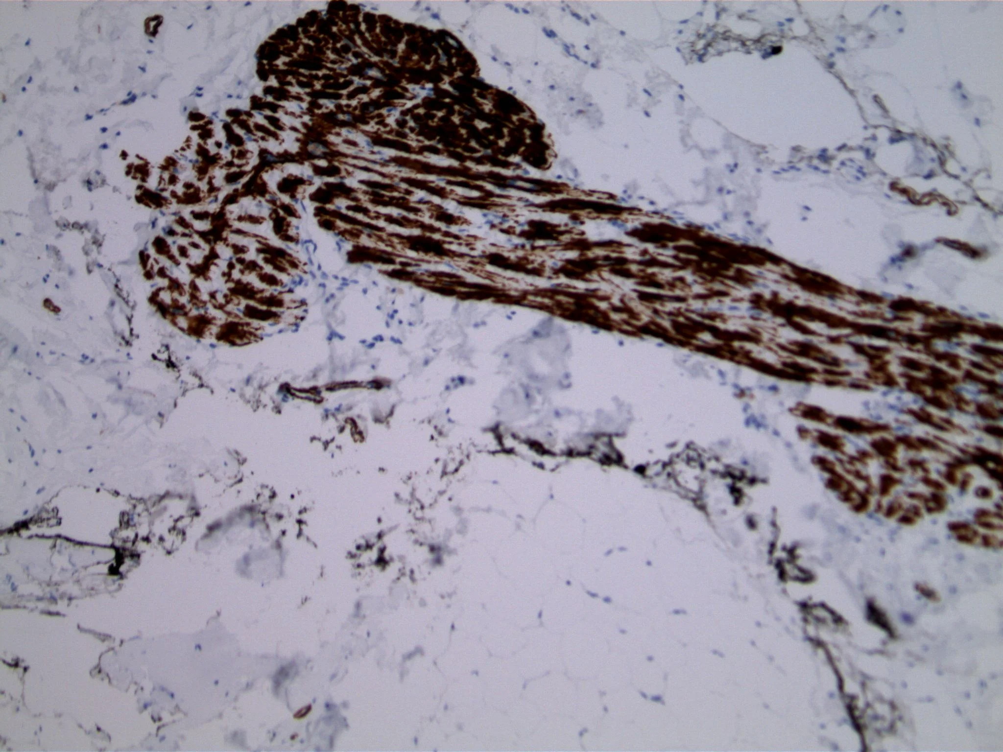 Image 5. Immunohistochemistry using antibodies to smooth muscle actin highlights prominent myoid component in a longitudinally cut terminal duct.