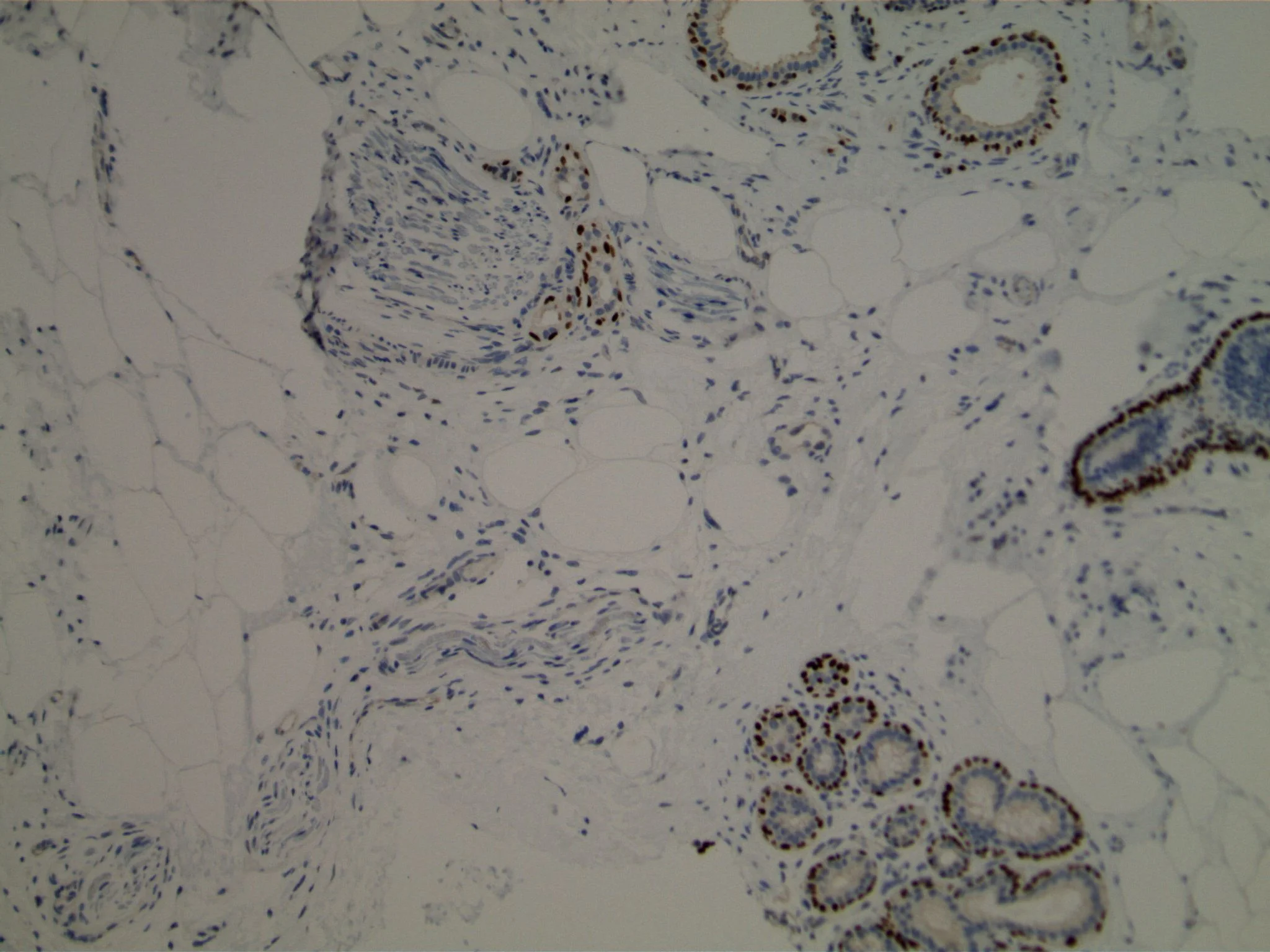 Image 3. Immunohistochemistry using antibodies to p63 highlight myoepithelial cells in normal acini and within the perineural glands.