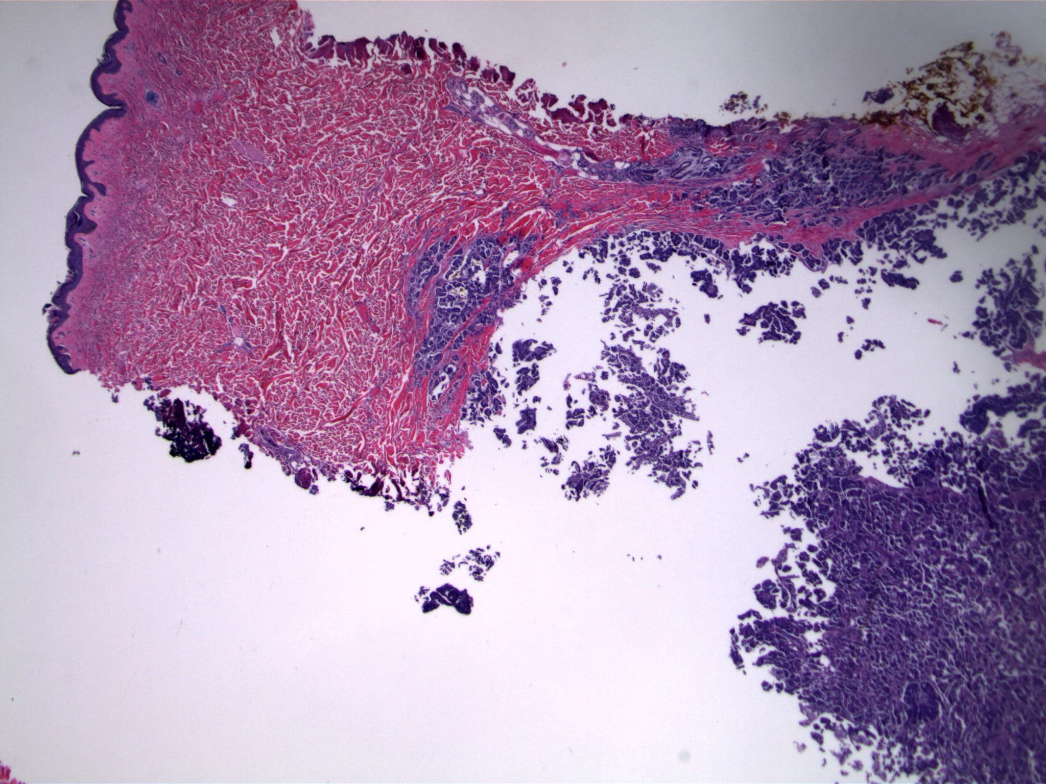Image 1. The dermis contains numerous small cellular clusters. Normal skin adnexal structures are present (upper center)