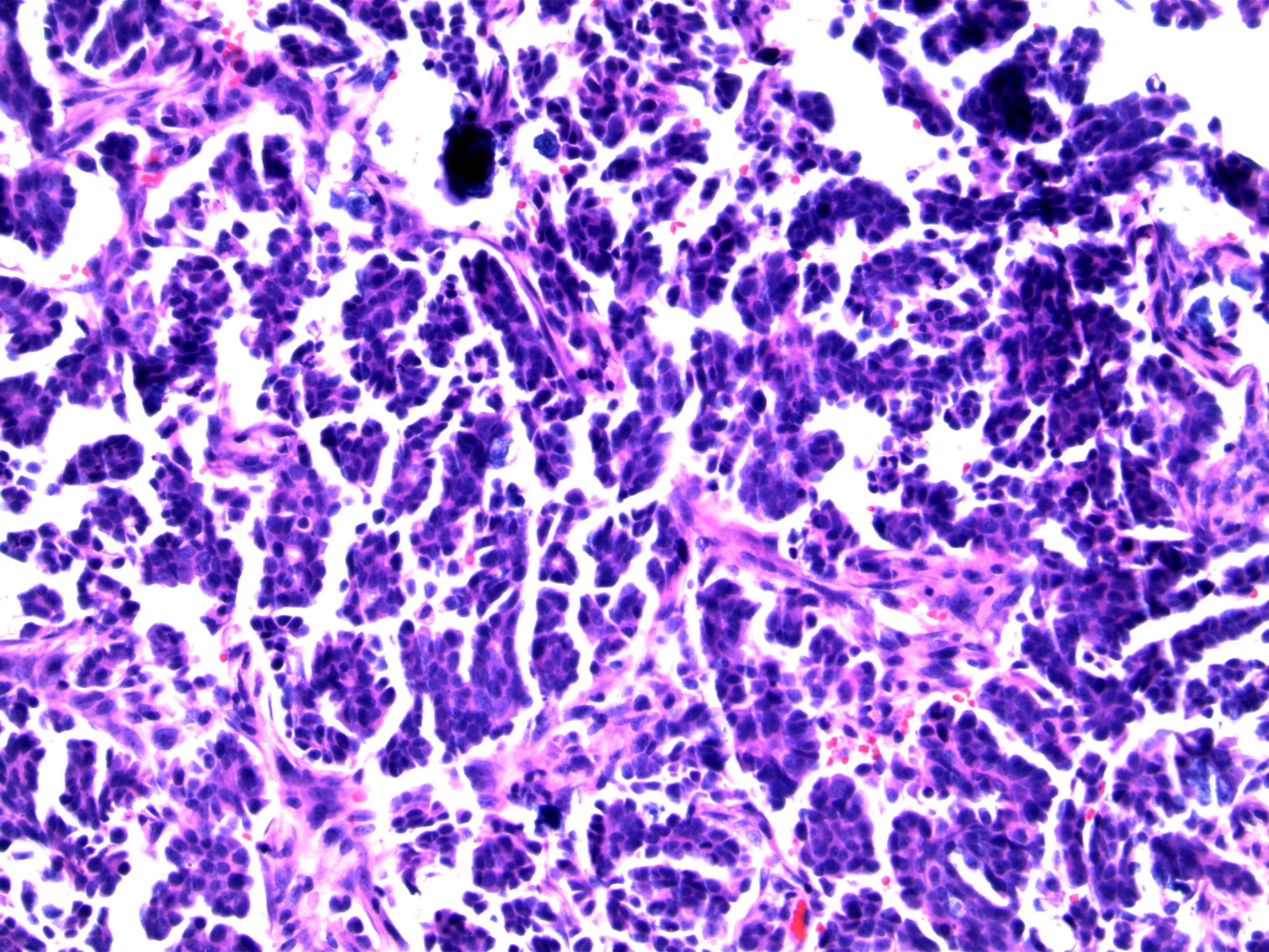 Image 3. Note presence of psammoma bodies. 