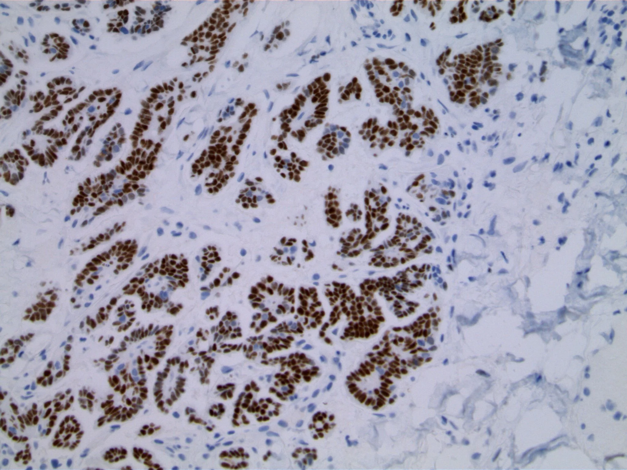 Image 4. Immunohistochemical study using antibodies to WT1 shows strong nuclear expression