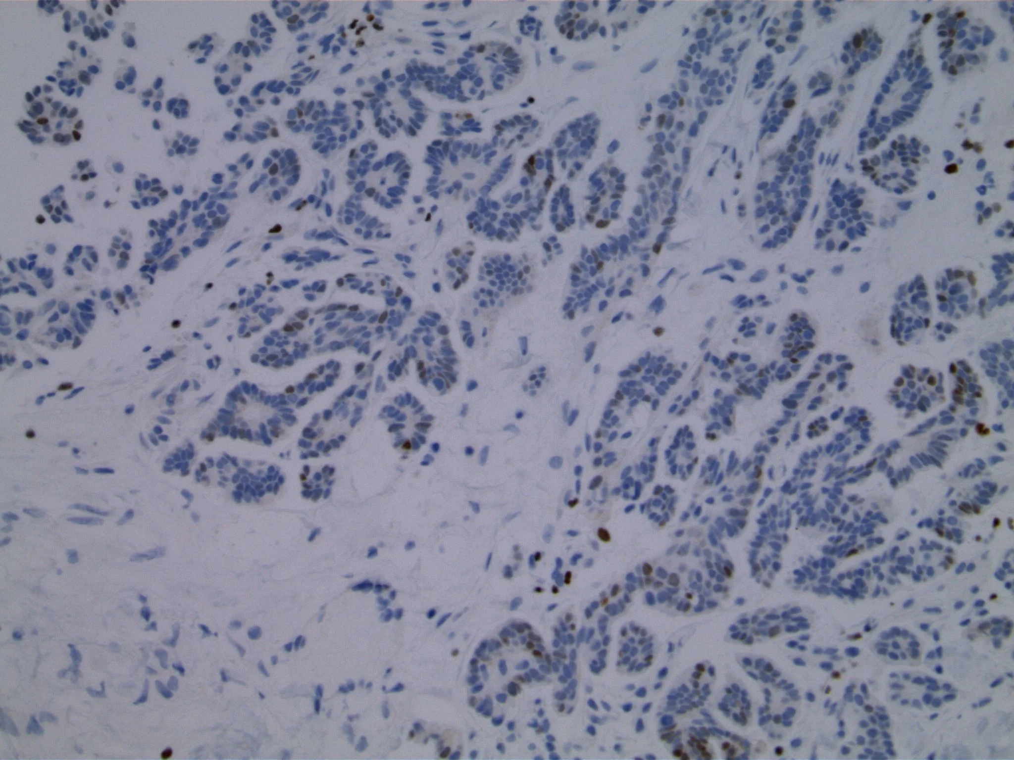 Image 5. Immunohistochemical study using antibodies to GATA-3 shows focal nuclear expression.