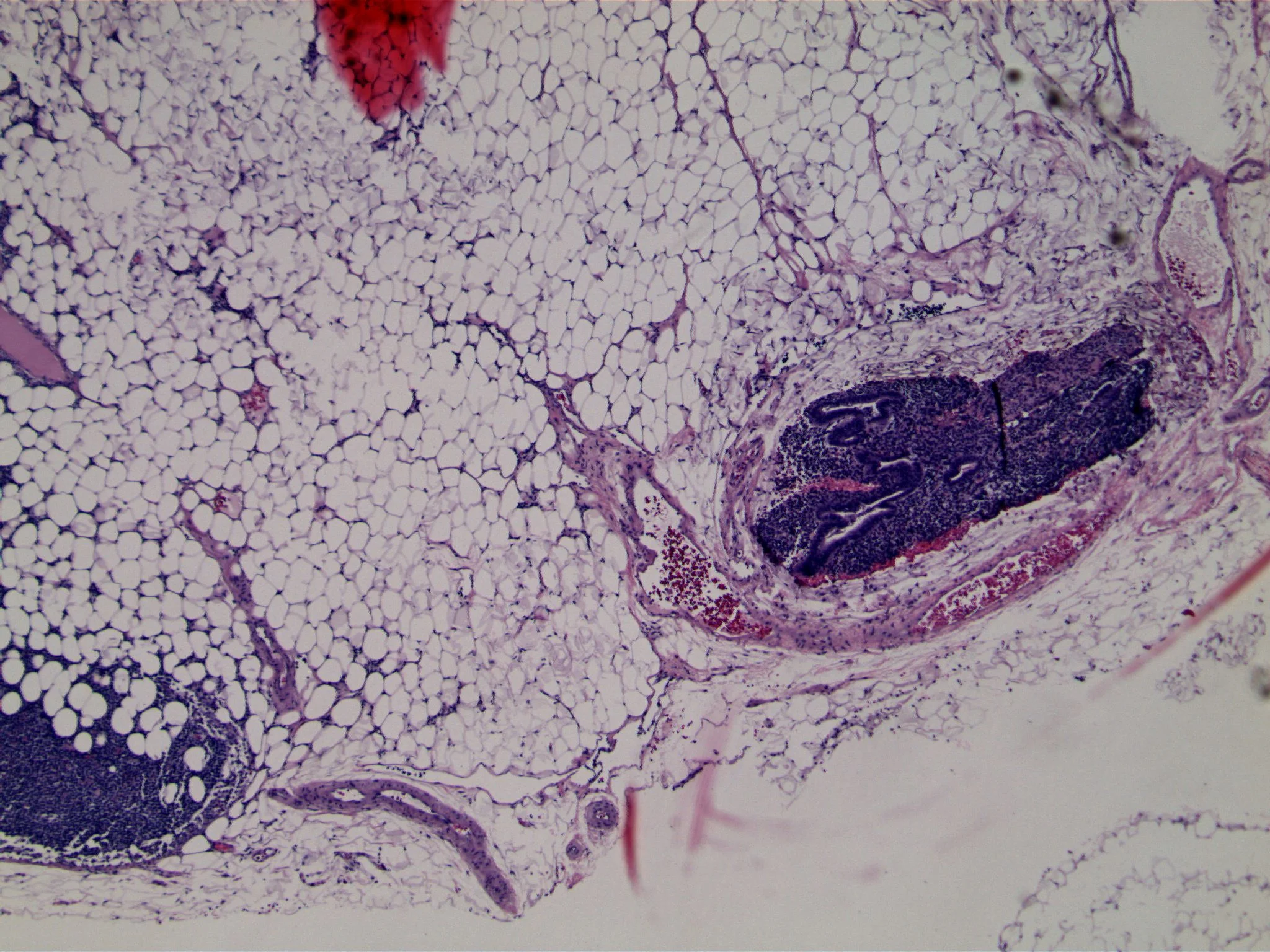 Image 5. Sentinel lymph node biopsy. A largely fatty lymph node contains nodal tissue (bottom left) and a glandular proliferation (right)