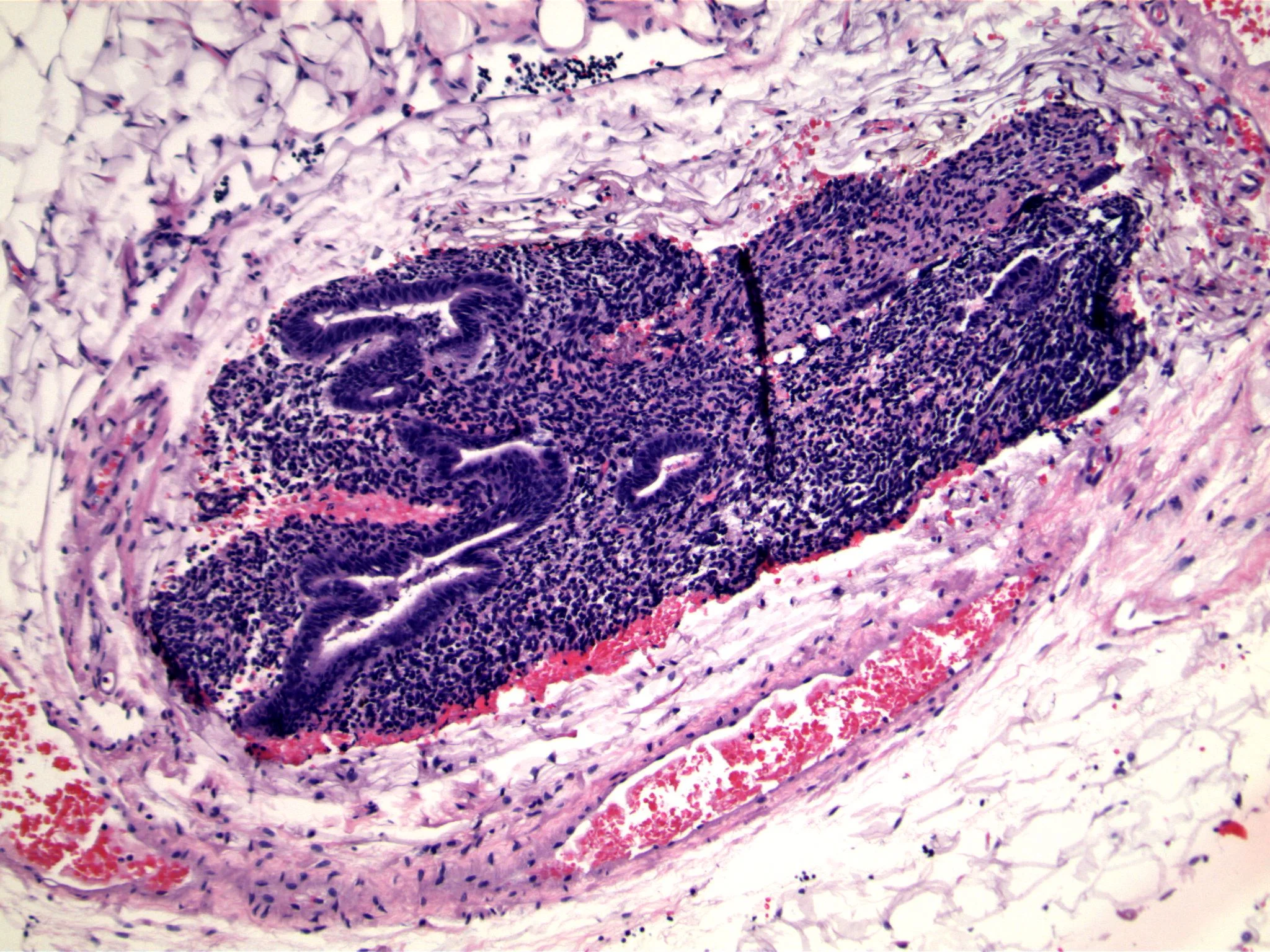 Image 6. Bland columnar epithelium is associated with small round to oval blue cells.