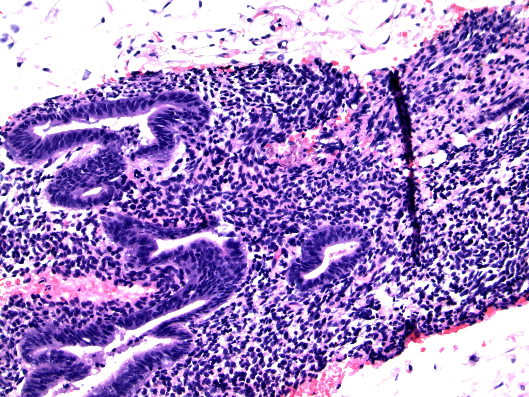 Image 7. The bland columnar cells are associated with slightly spindled stromal cells and fibrin thombi
