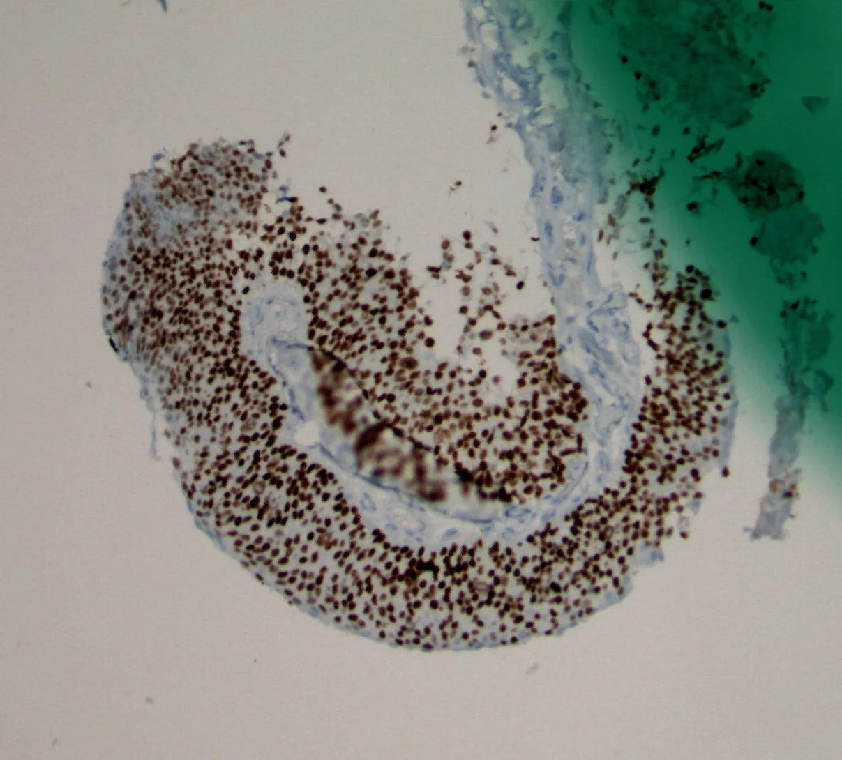 Image 3. Immunohistochemical study shows diffuse, strong nuclear expression of p63.