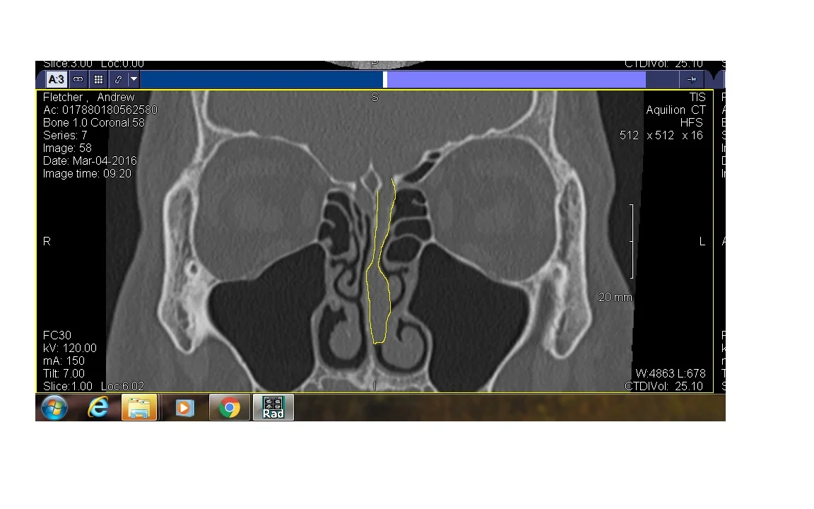 Yellow outline of Long skinny tumor