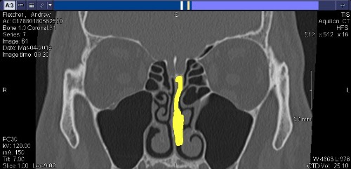 Yellow outline of the polyp in my left nose/sinus