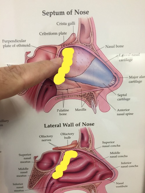 Yellow outline of the size and location of my tumor