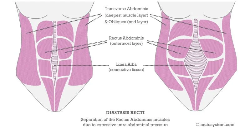 How Obesity Caused My Diastasis Recti The Curious Coconut