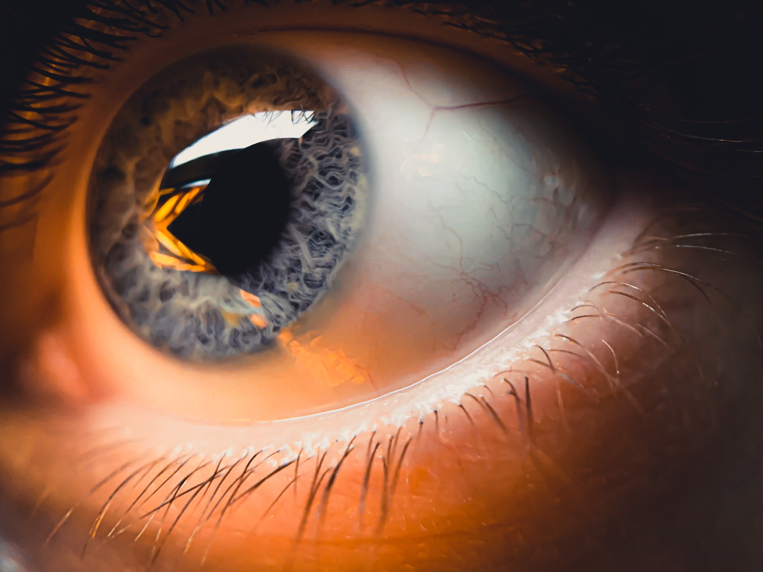 Keratoconus: Causes, Consequences, and Treatment Options