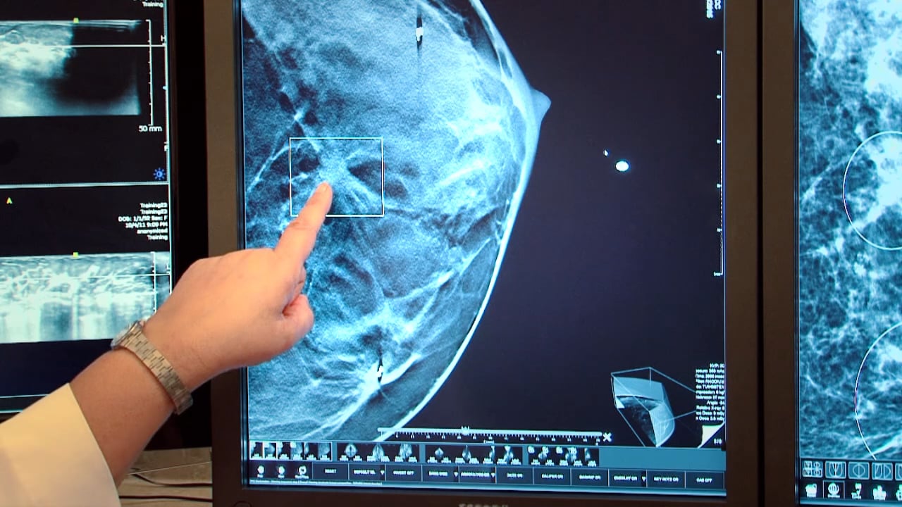 Screening Comparison
