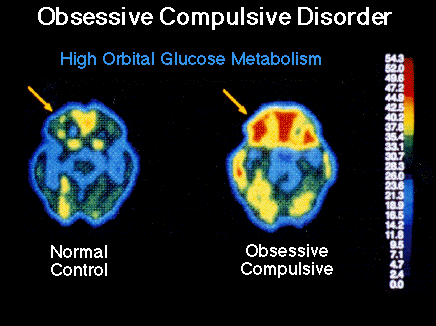 From the work of Lewis Baxter, MD, UCLA, 1992