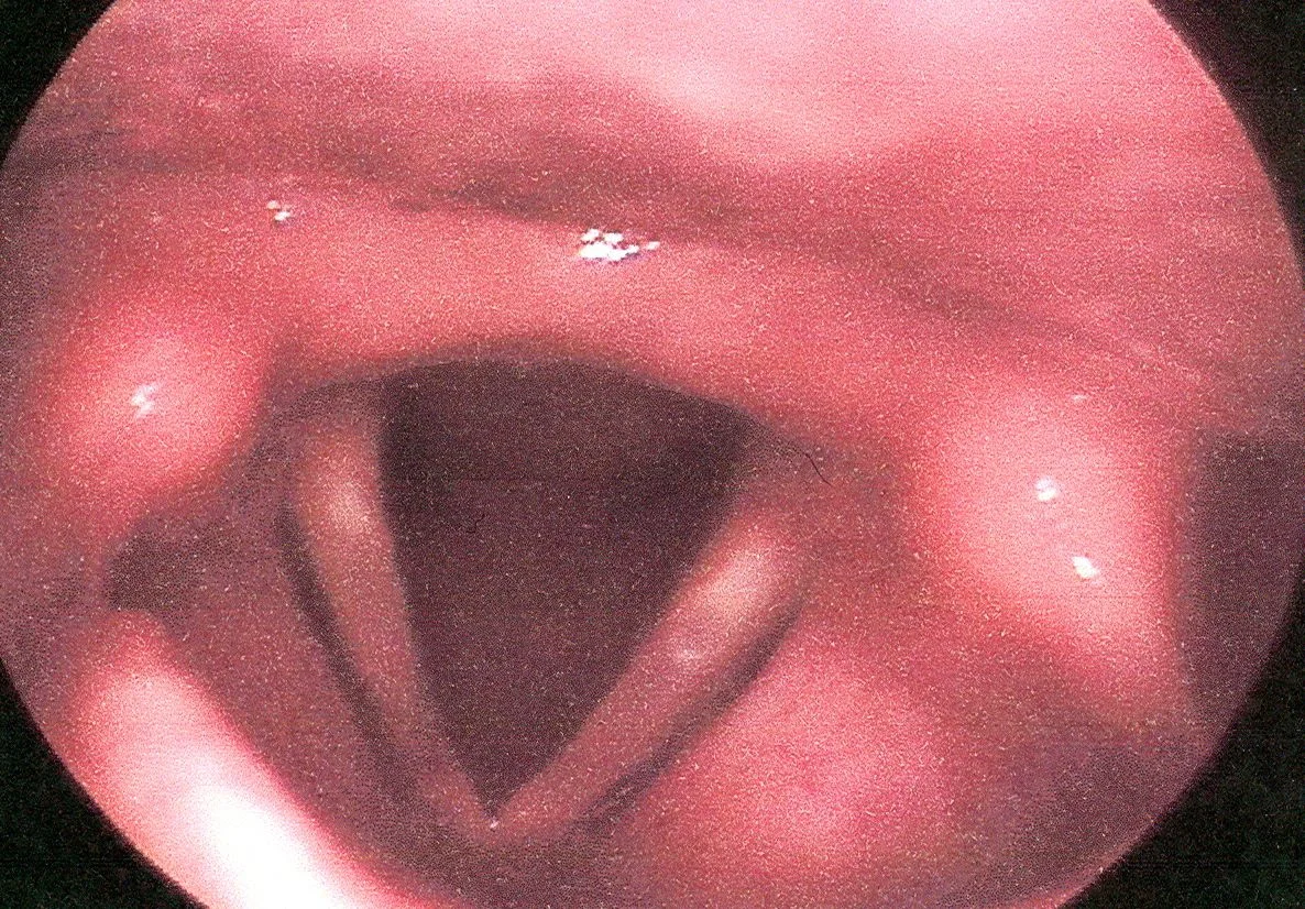 My vocal cords: the left cord is slow to meet up with the right, due to a slightly weakened superior laryngeal nerve.