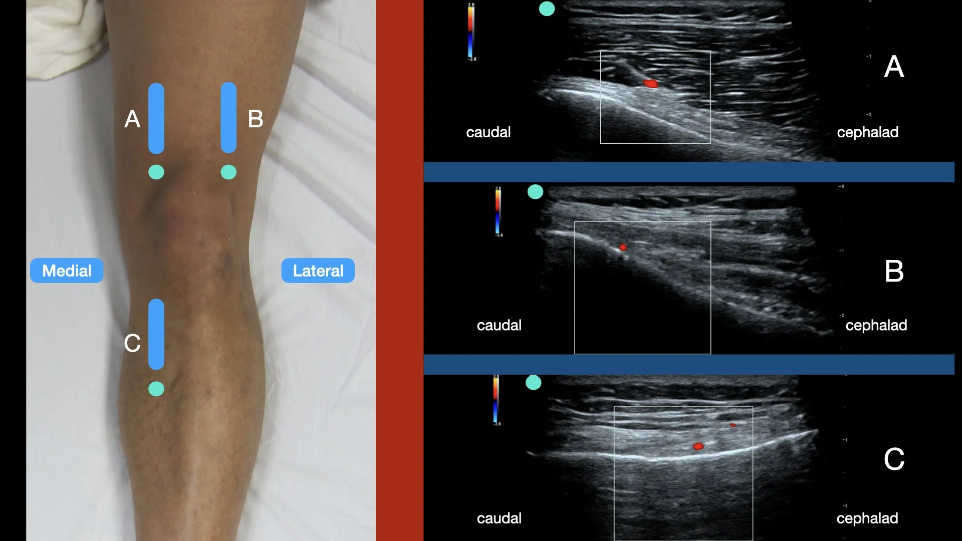 Genicular Nerve Block — Highland EM Ultrasound Fueled pain management