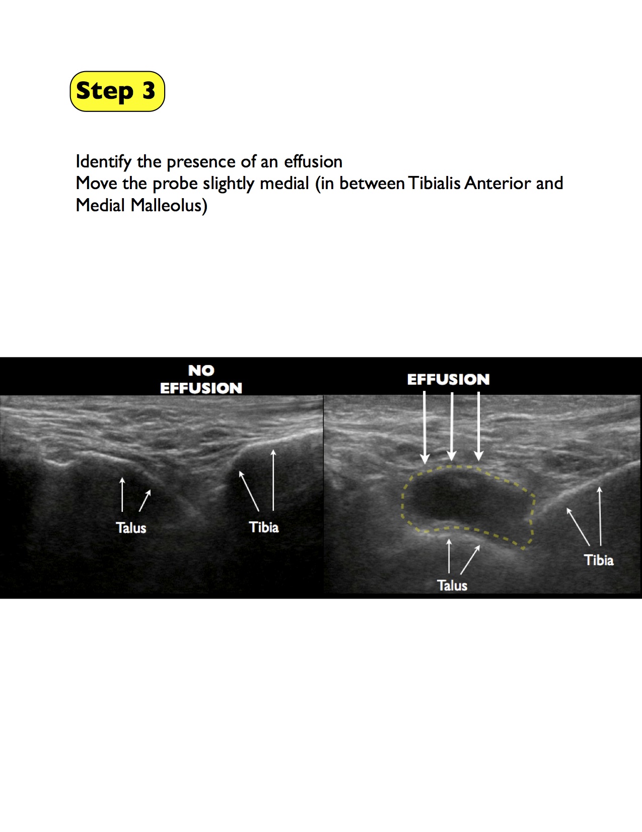 3 ankle arthrocentesis final.jpg