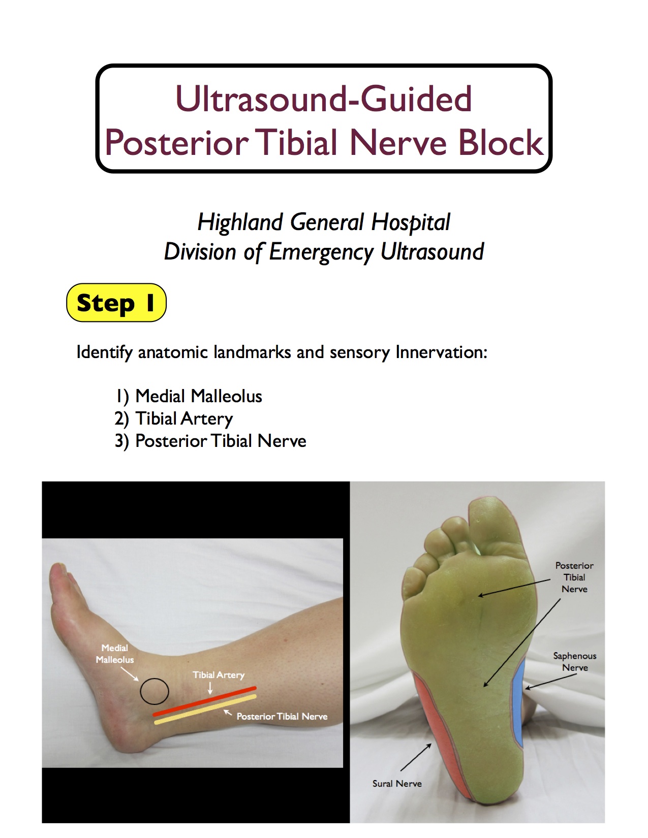 posterior tibial highland em ultrasound fueled pain management tibial nerve