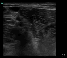 Out-of-plane interscalene block with the needle tip kept well away from the spinal roots