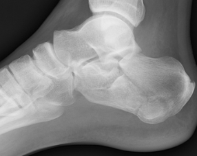 calcaneous fracture.png