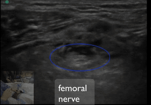FEMORAL3.gif
