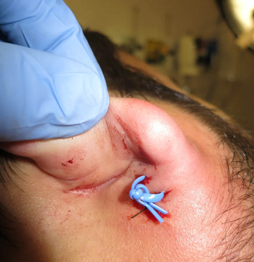 Ear Digital Block Face,Head & Neck — Highland EM Ultrasound Fueled pain management