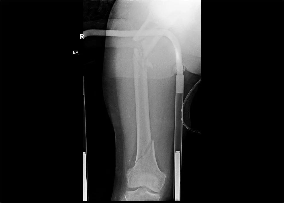 PH Femur_300dpi.jpg