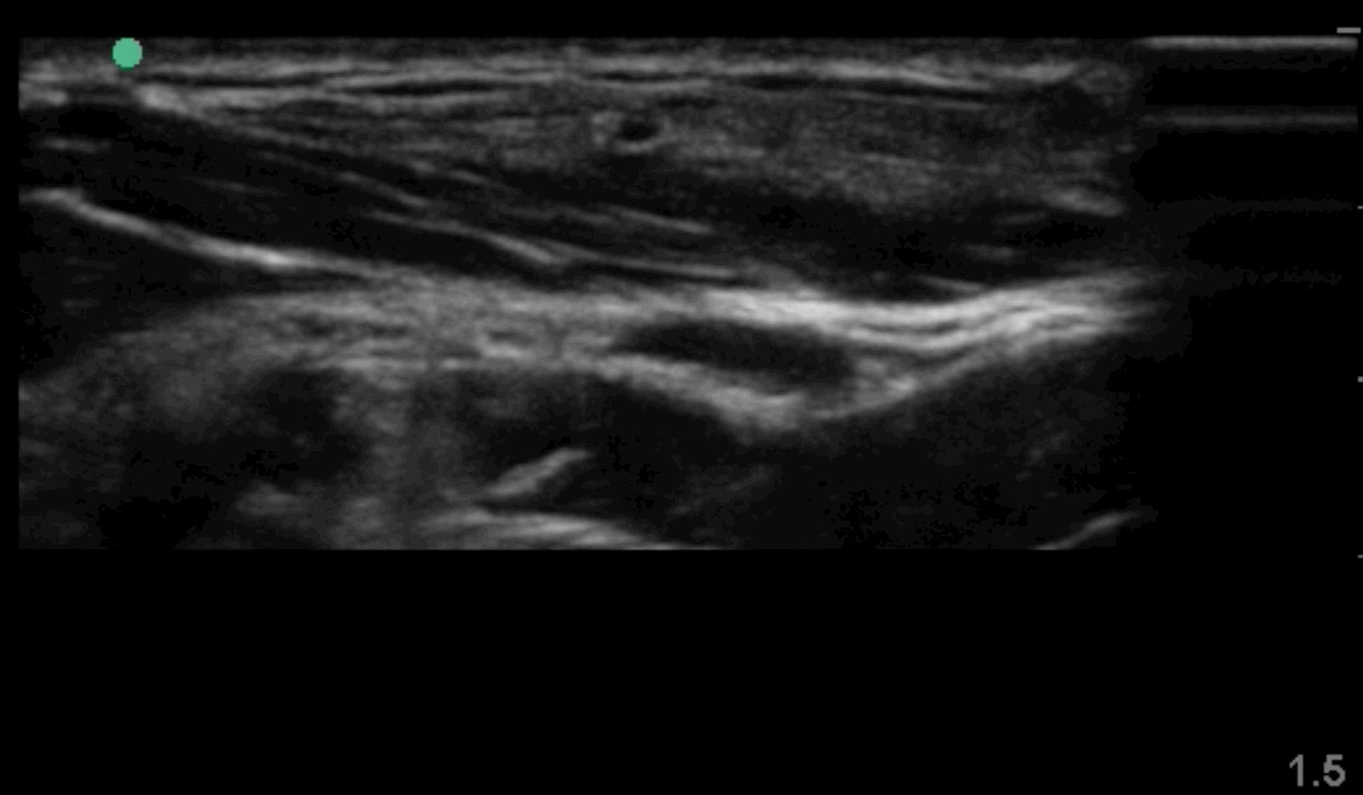 The key to locating the nerve from the "noise" in the shallow subcutaneous area over the SCM is to trace it lengthways as it courses superiorly and medial over the SCM from its exit at the C6 level to the ear.