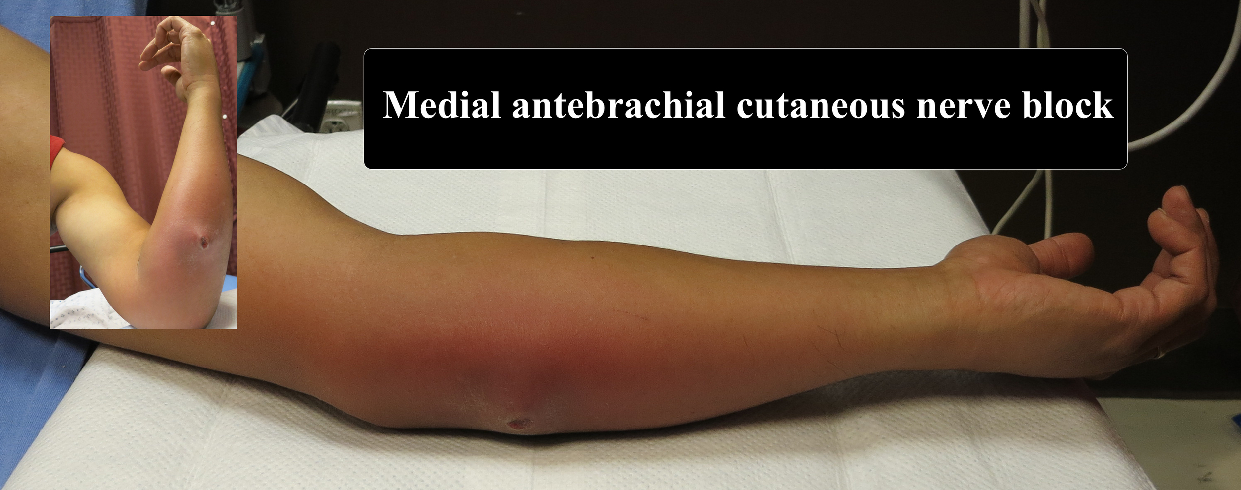 Posterior medial forearm abscess not improving with soaks and warm compresses; patient requesting to have it "opened up."