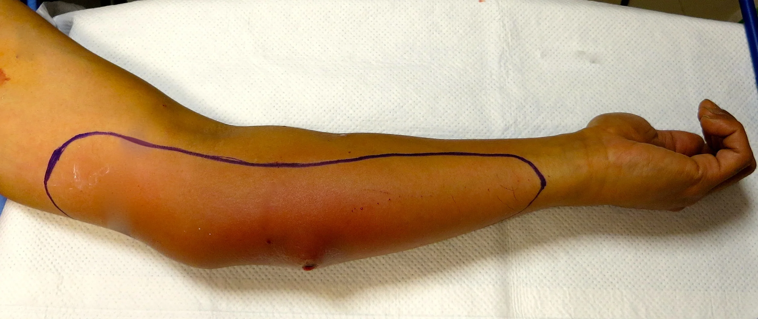 Area of anesthesia after an ultrasound-guided medial antebrachial cutaneous block was placed.