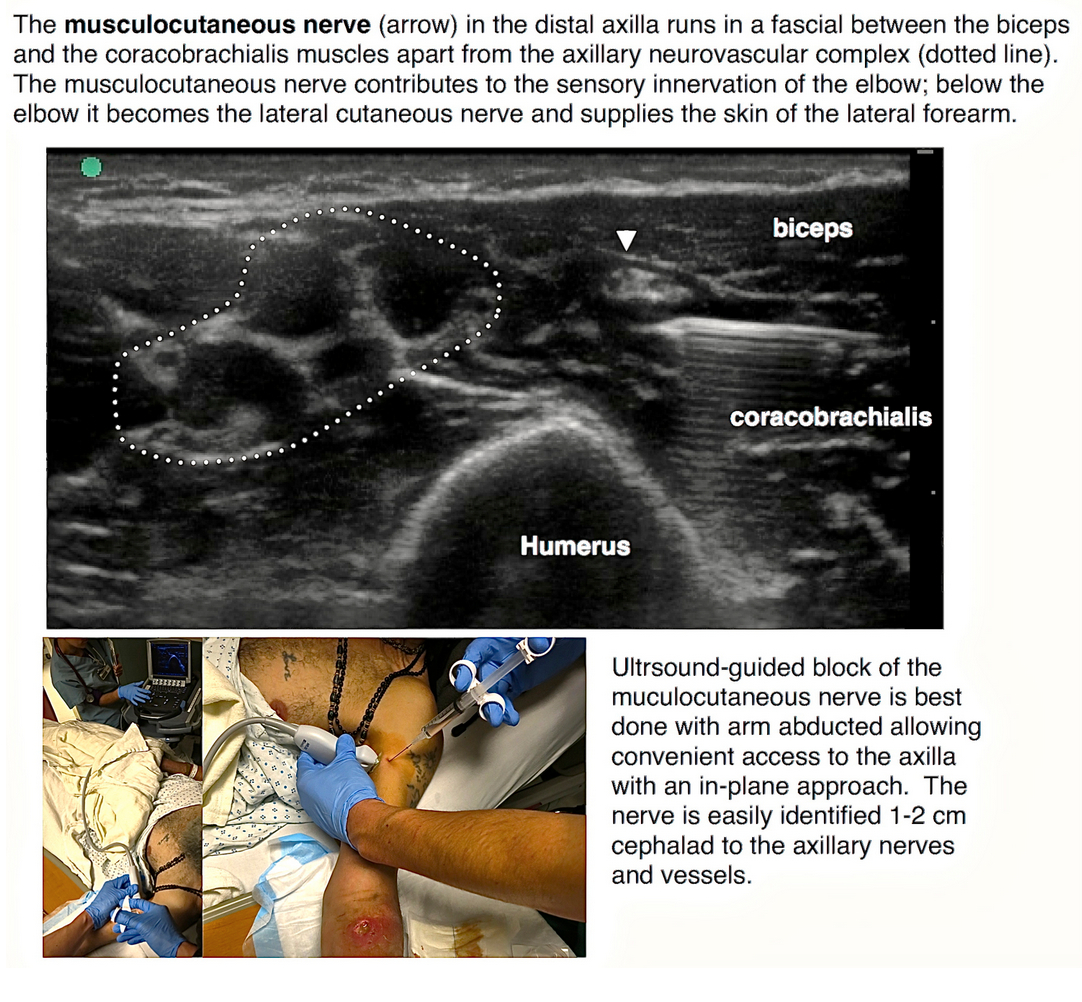 Ultrasound-guided block for the medial forearm — Highland EM Ultrasound