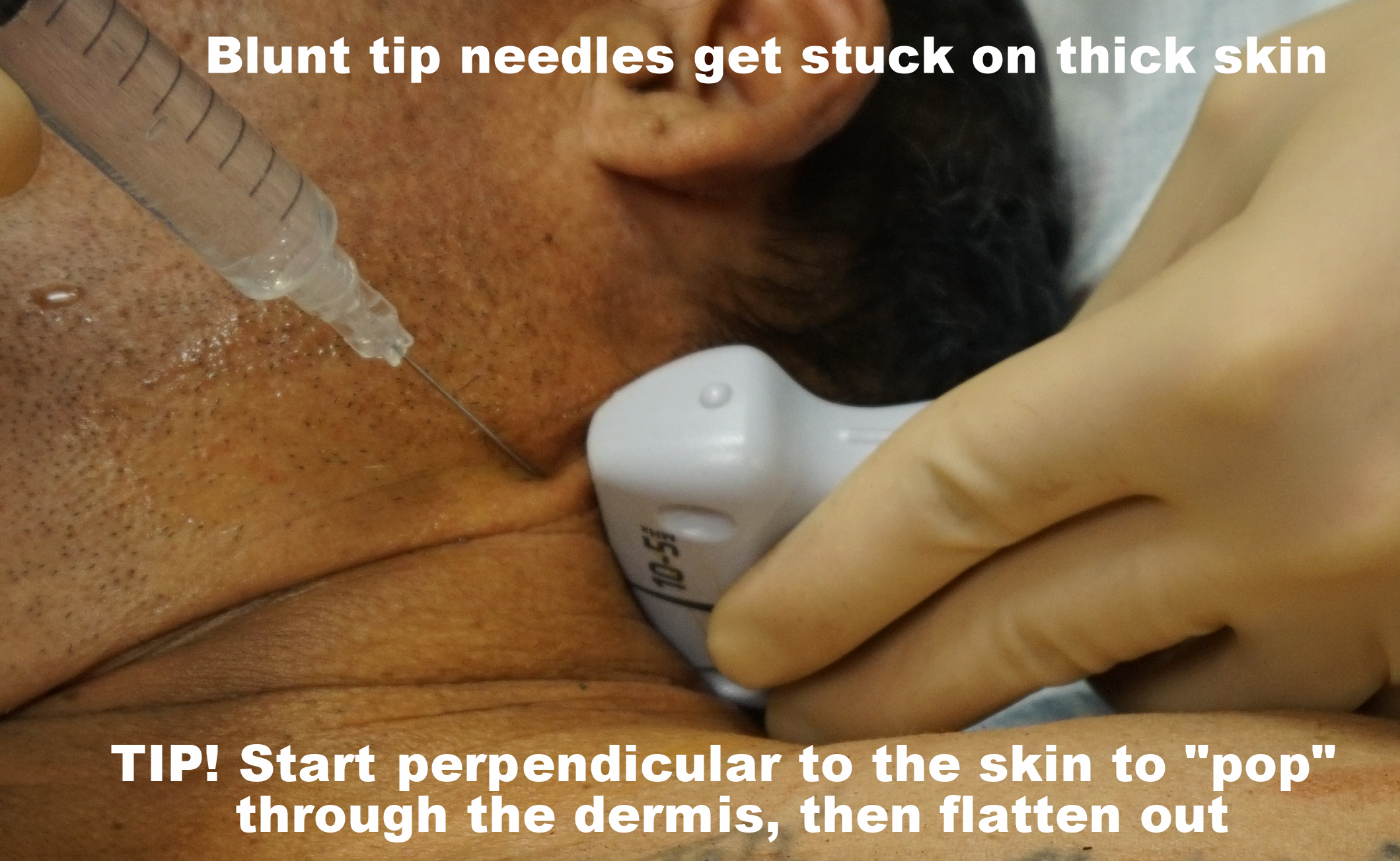 blunt needle problems crop.jpg