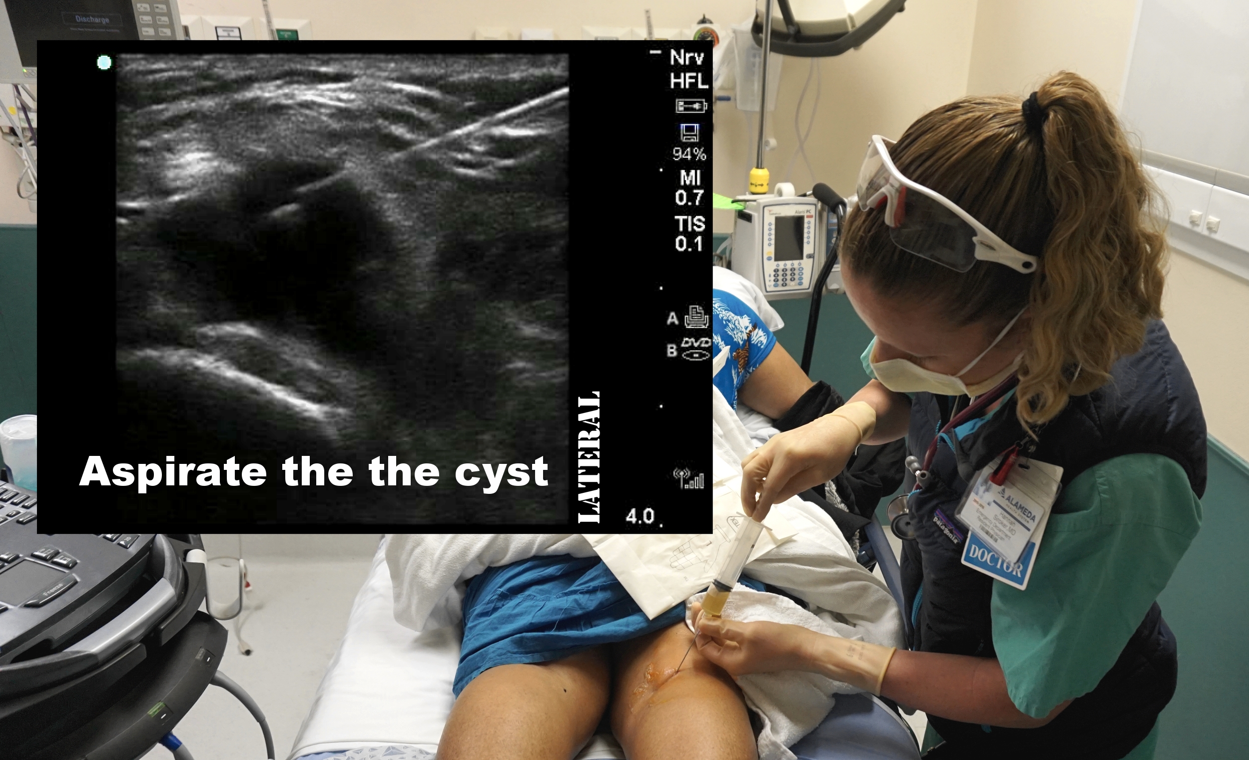 Bakers Cyst — Highland Em Ultrasound Fueled Pain Management