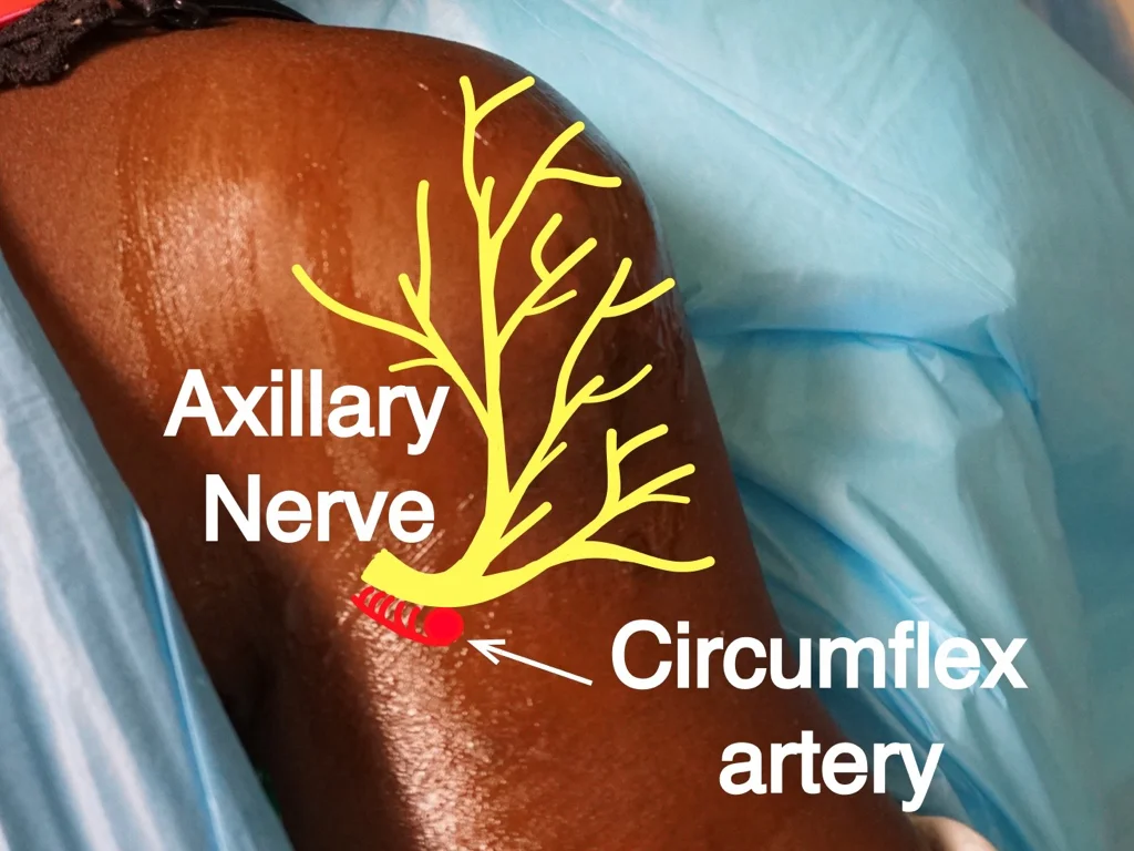 Axillary Nerve (deltoid) — Highland EM Ultrasound Fueled pain management