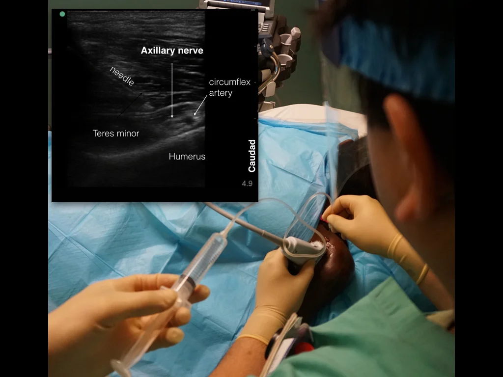 Axillary Nerve (deltoid) — Highland EM Ultrasound Fueled pain management
