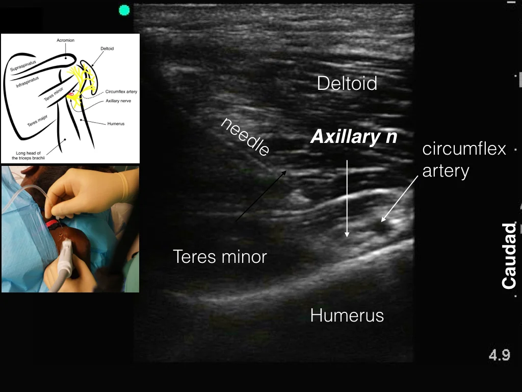 Axillary Nerve (deltoid) — Highland EM Ultrasound Fueled pain management