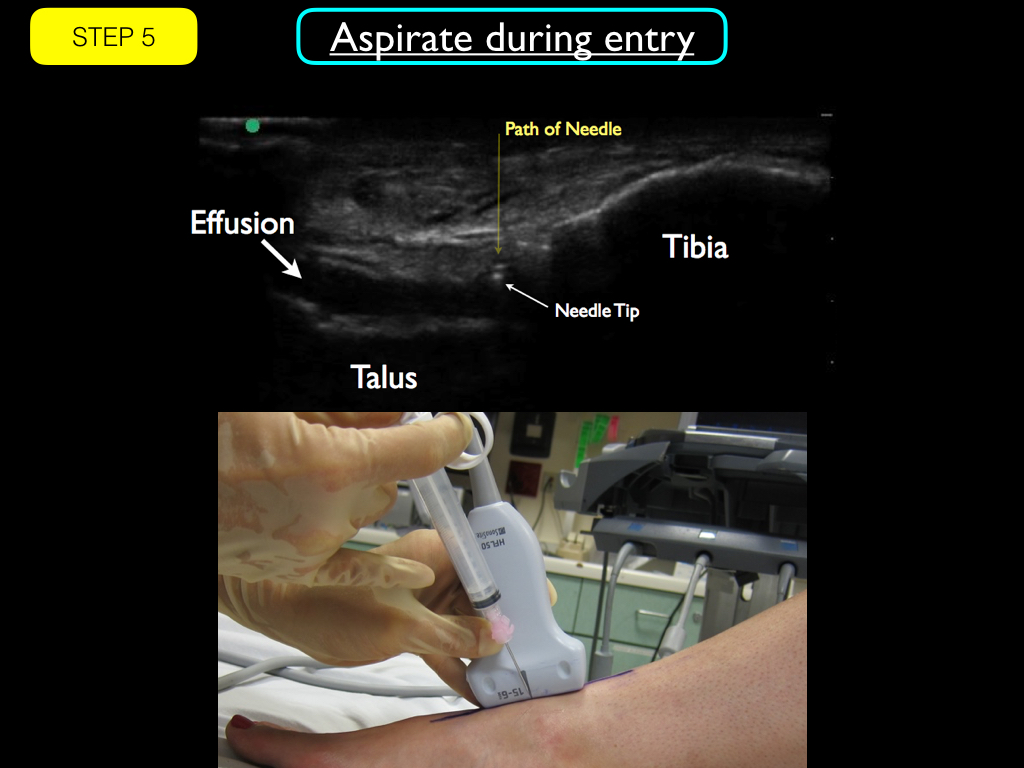 ankle arthrocentesis ultrasound.005.jpeg