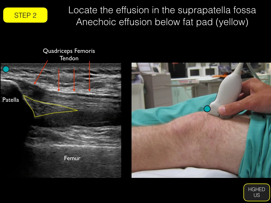 Arthrocentesis: Knee — Highland EM Ultrasound Fueled pain management