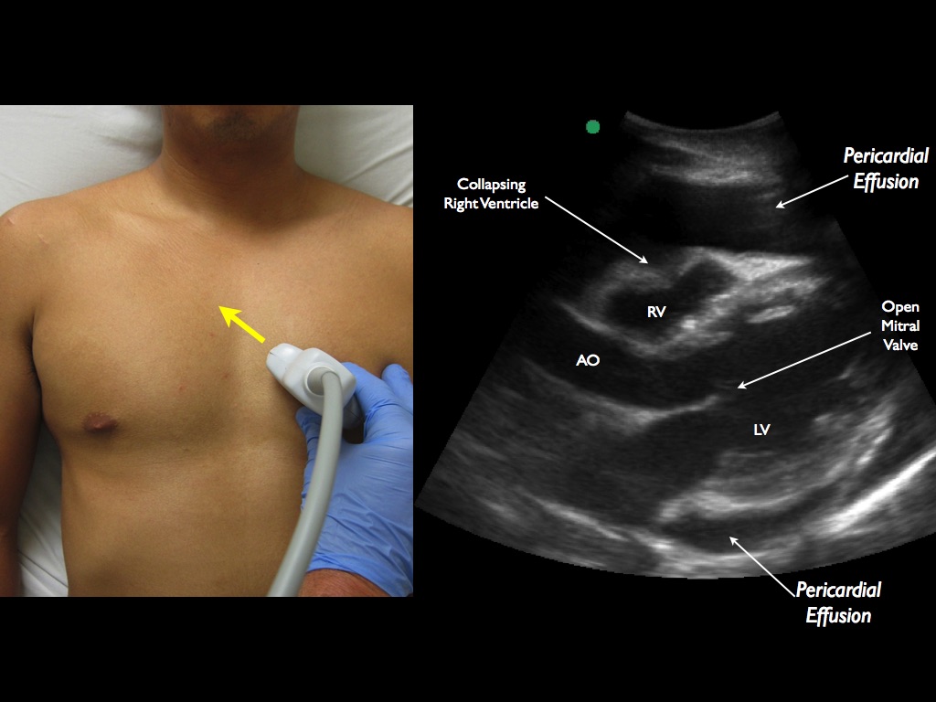 1) Curvilinear Probe 2) Probe marker to the patient’s right shoulder 3) Adjust probe to find largest pocket of fluid