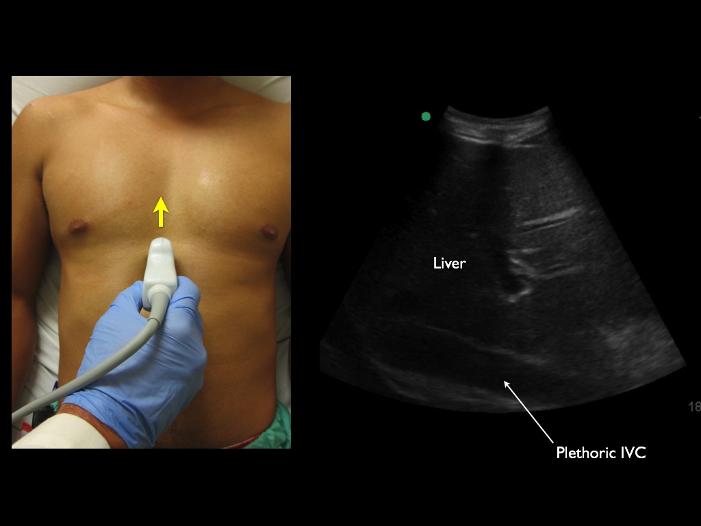 **Tamponade is a clinical diagnosis. A plethoric IVC may assist in determining elevated right sided pressures.